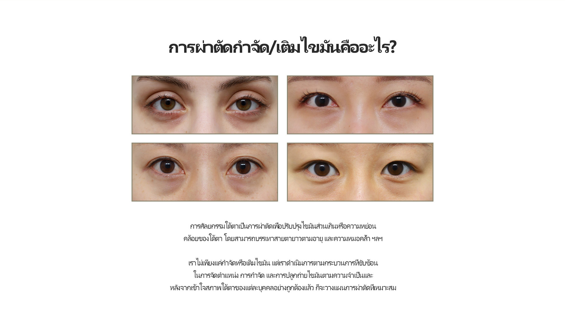 눈밑지방재배치/제거