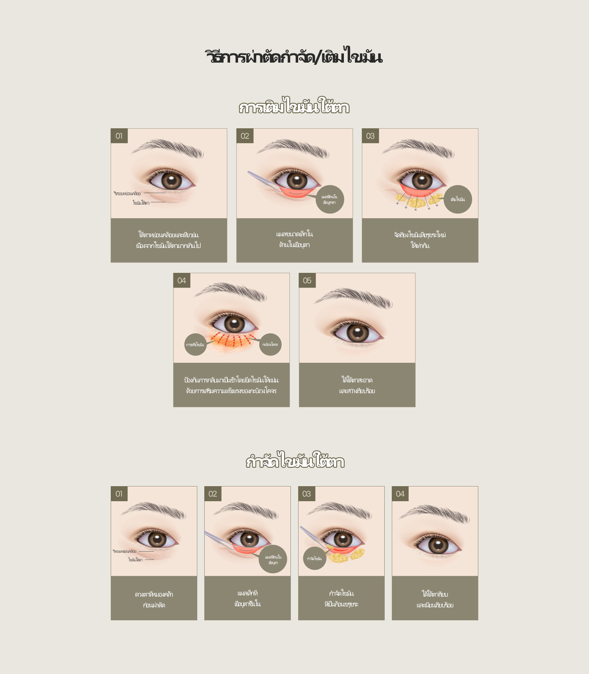 눈밑지방재배치/제거