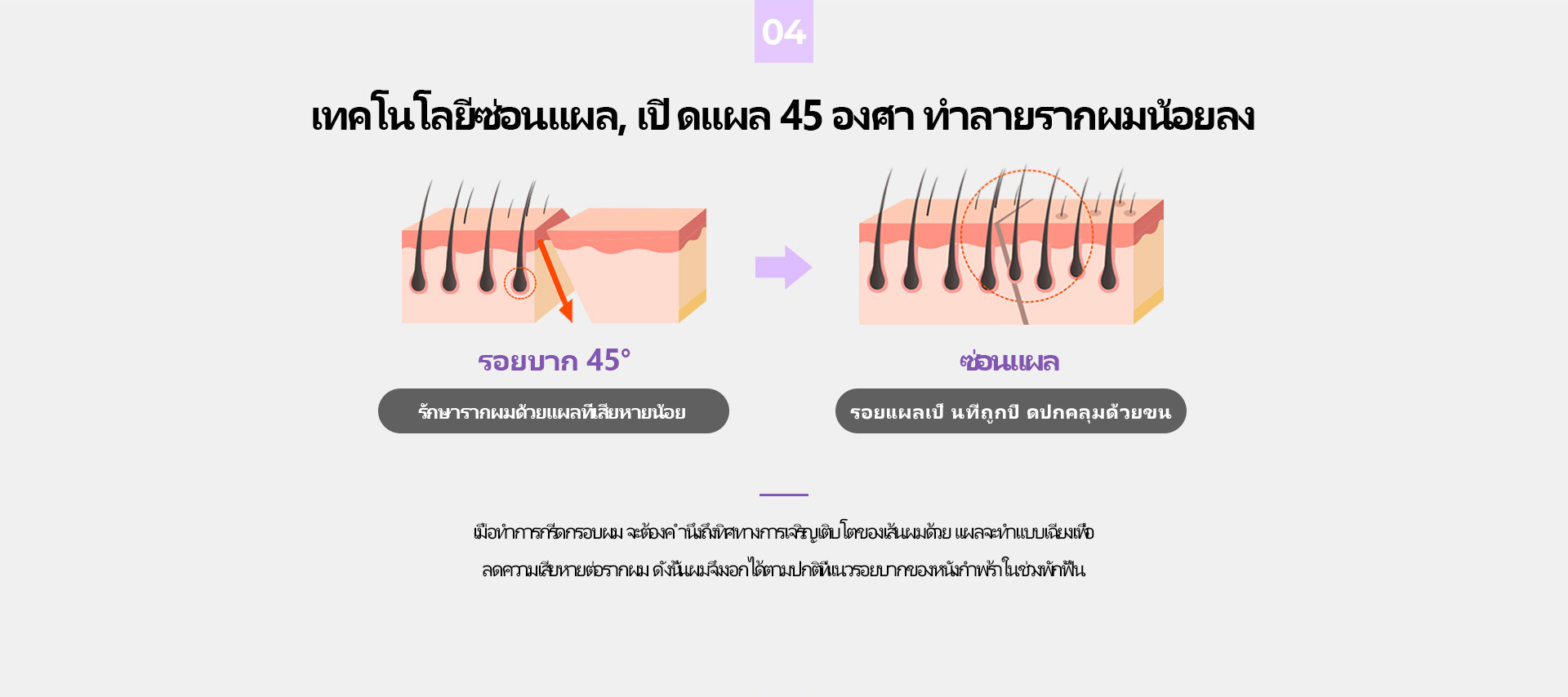 시그니처 이마축소