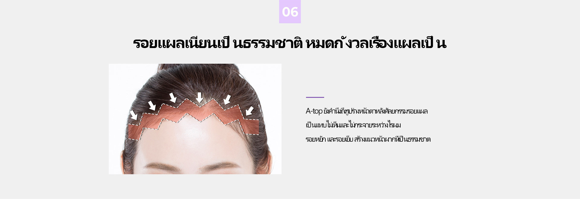시그니처 이마축소