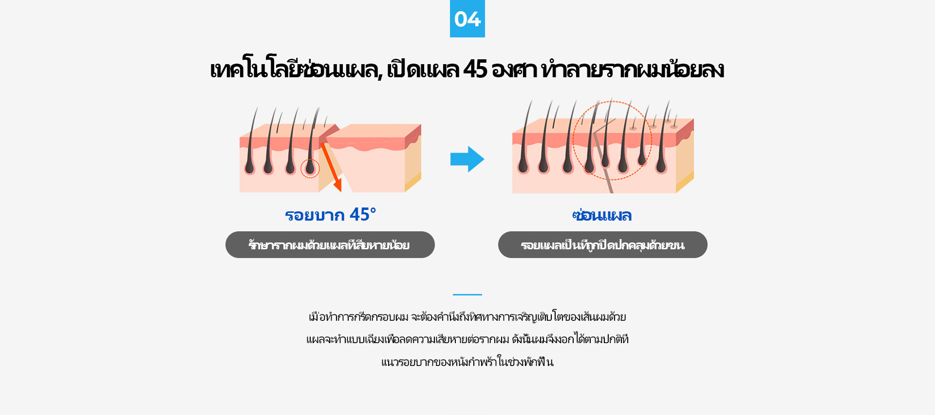 이마축소 재수술