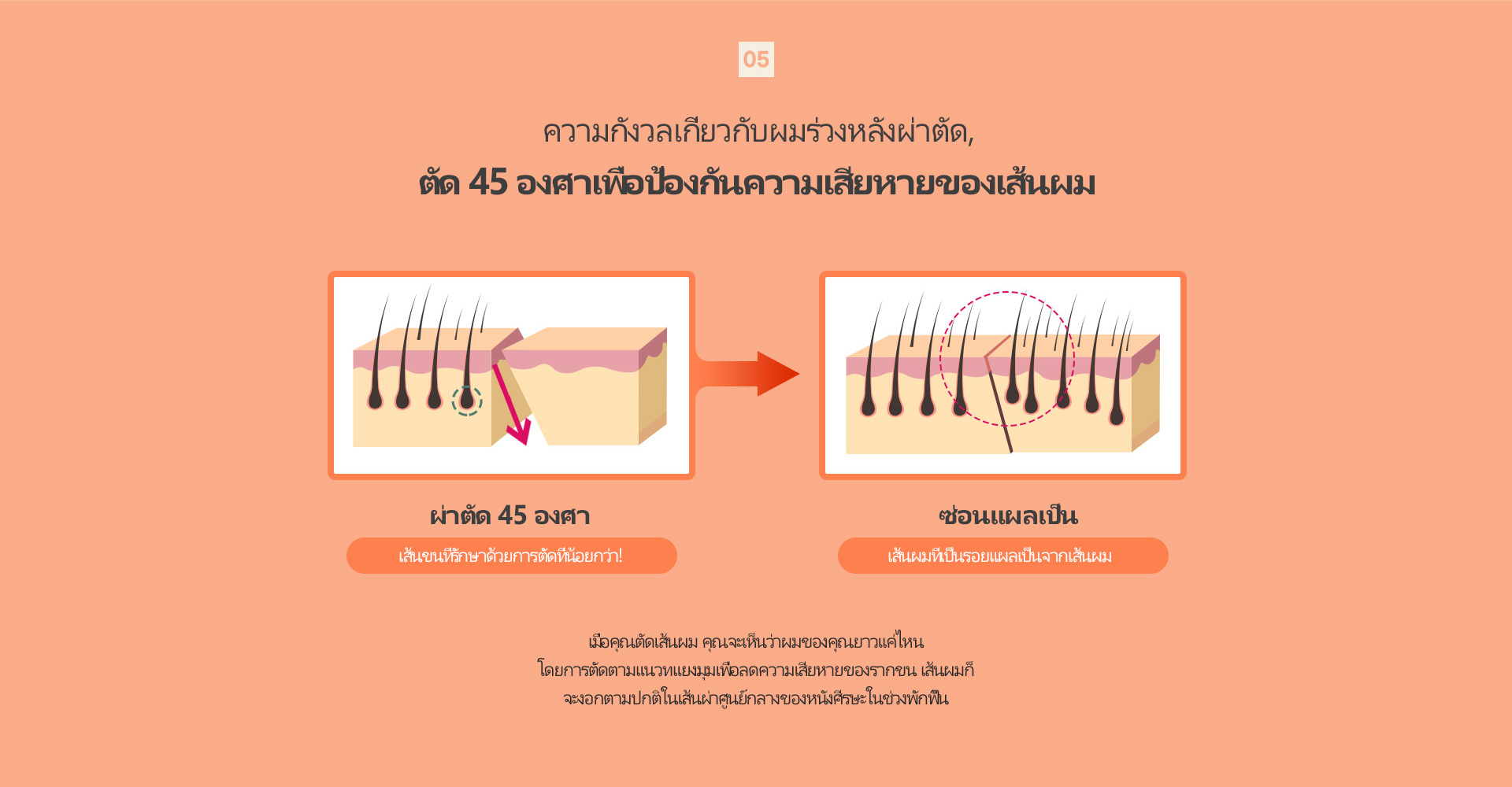 커스텀리프팅