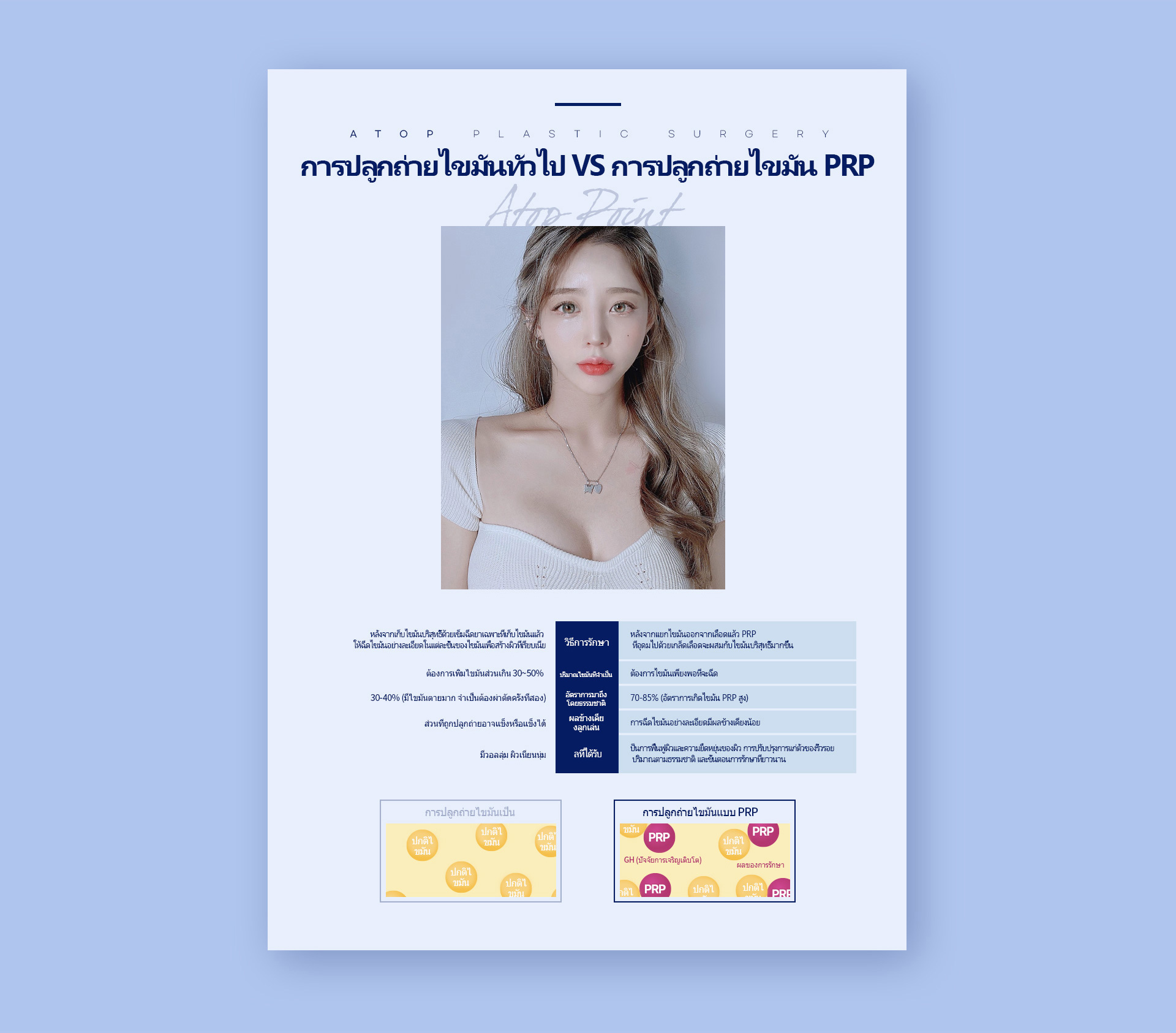 포인트지방이식