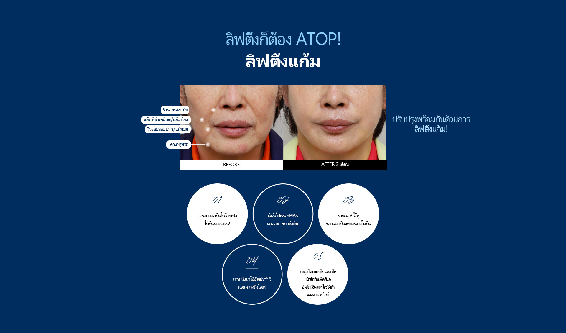 심술보리프팅