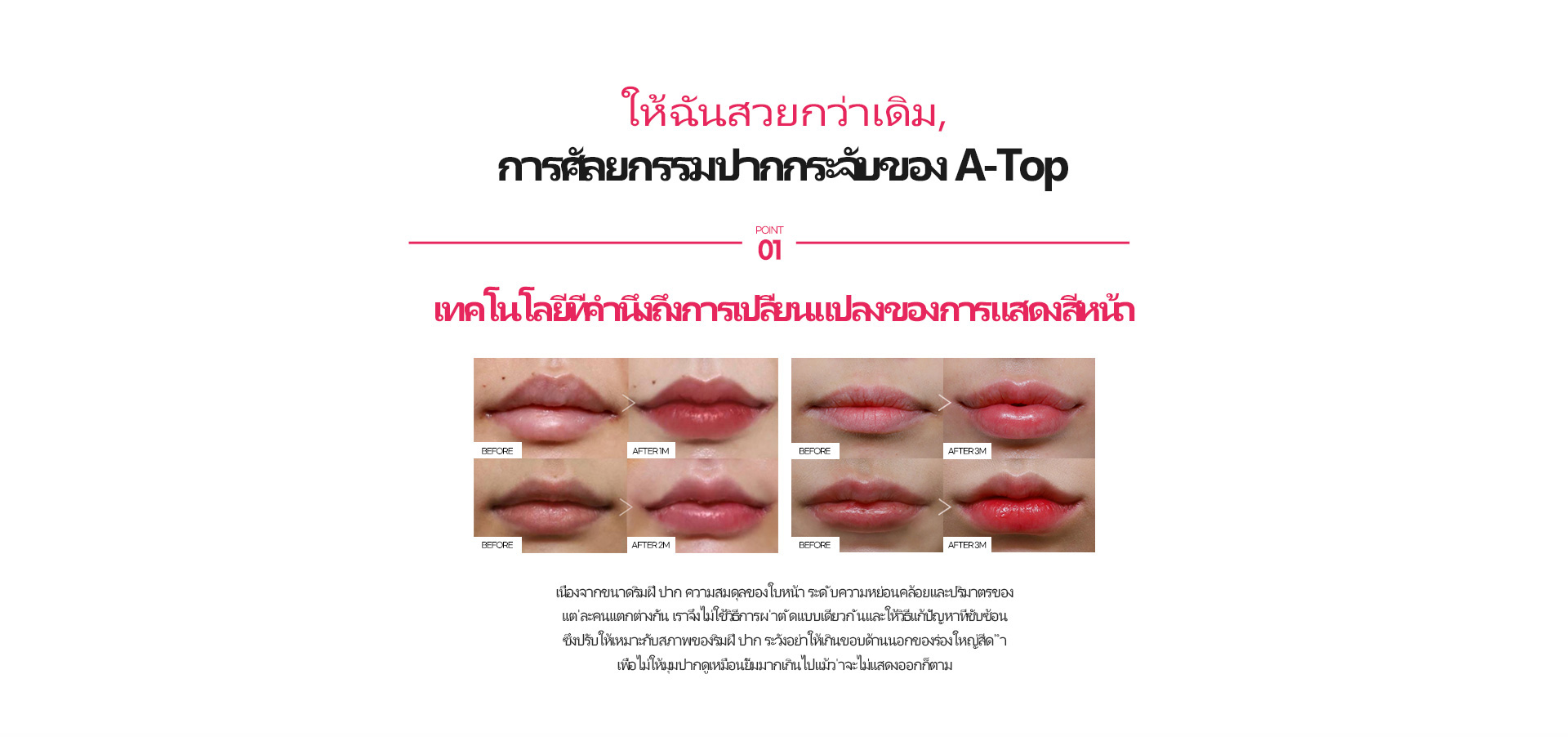 입술성형