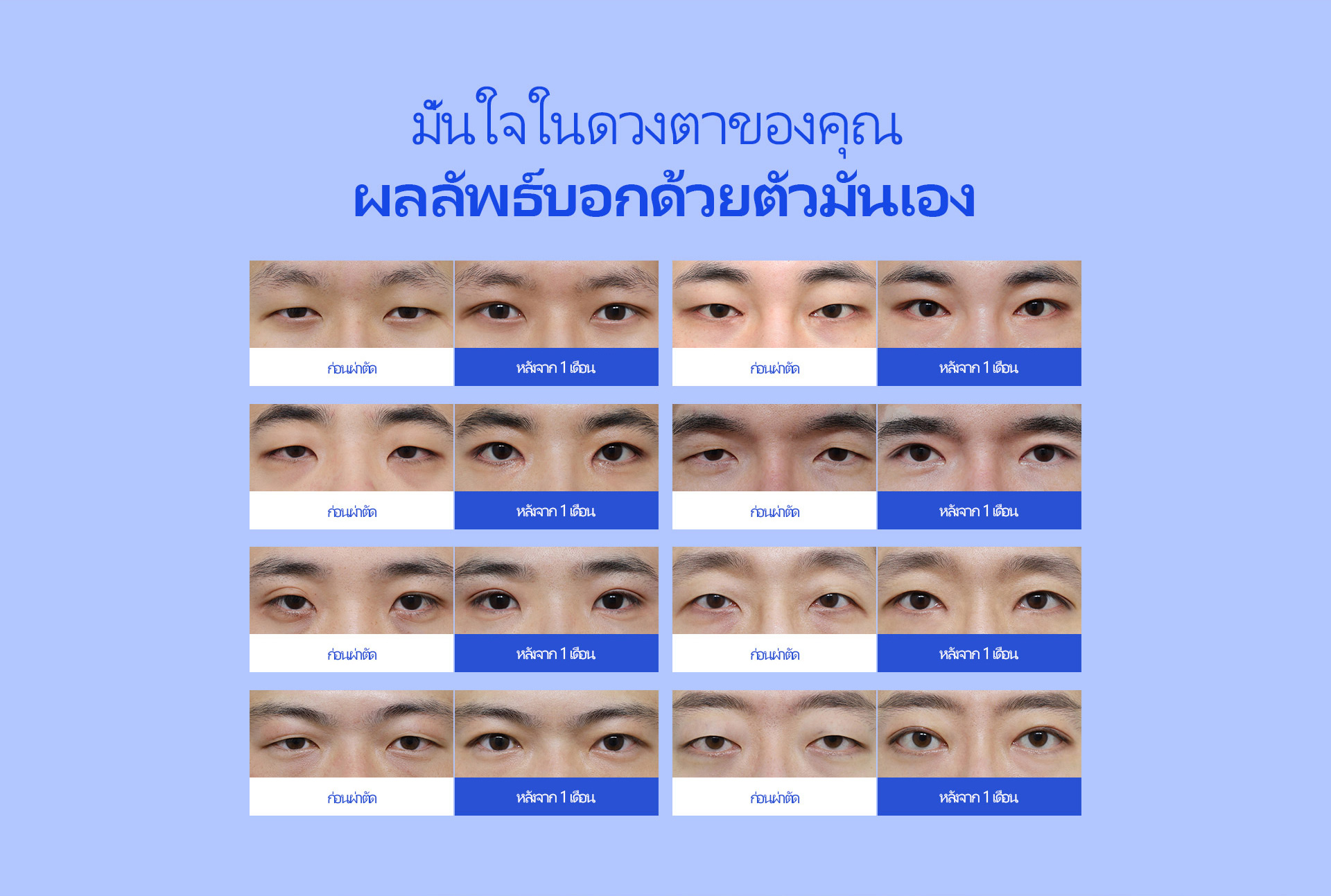 슬림라인 눈성형