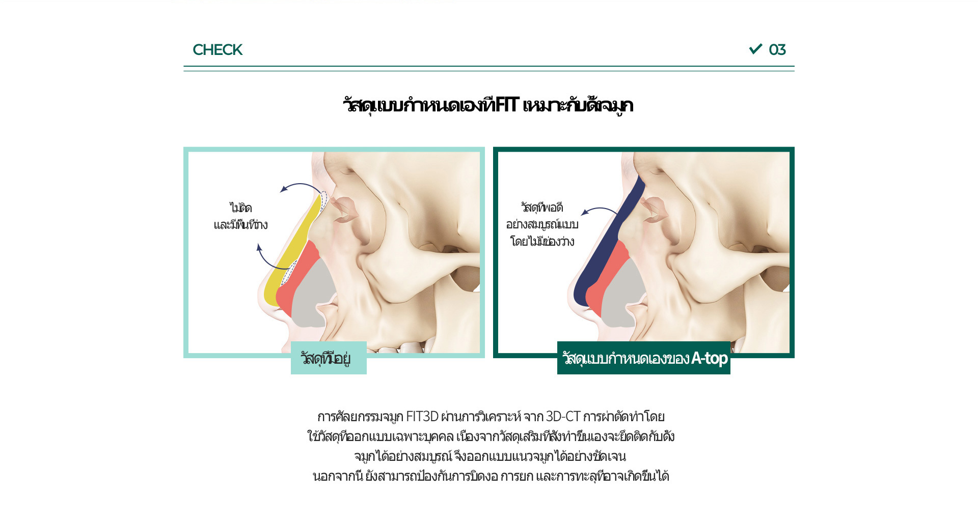 코재수술