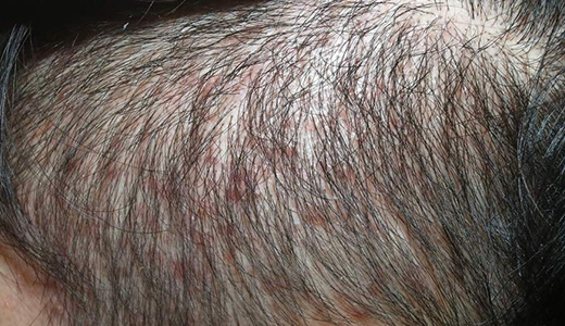 지루성 피부염 01