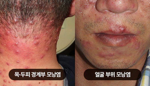 지루성 피부염 01