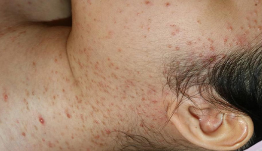 지루성 피부염 01